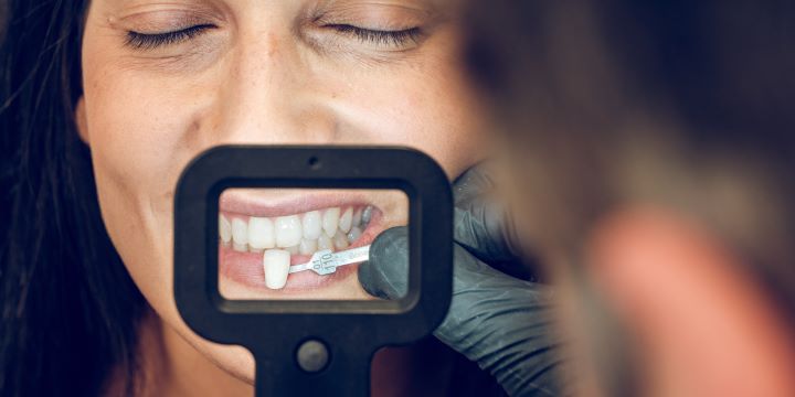 How Much Do Veneers Cost?